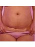 C-Section Silicone Scar Patches 6pk