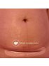 C-Section Silicone Scar Patches 6pk
